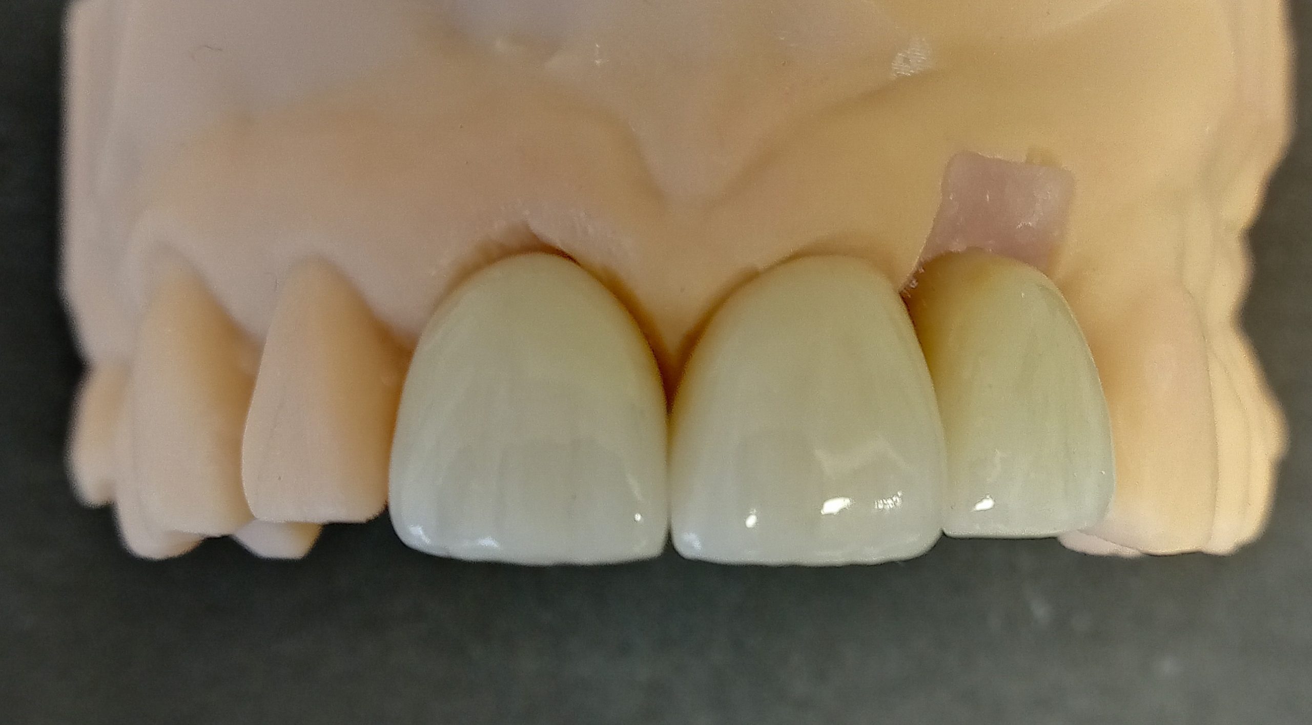 Multi-unit crown and implant case