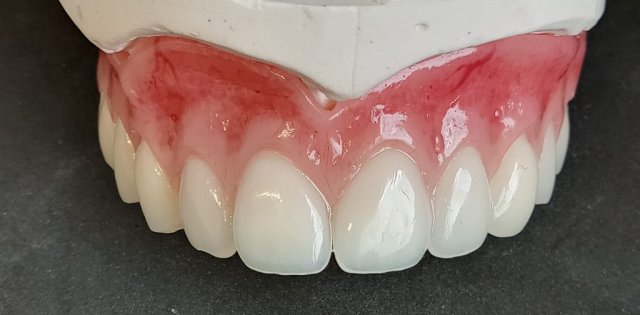 Full upper denture with detailed cum staining