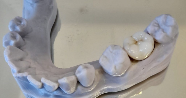 Zirconia crown designed and milled using CAD/CAM technology