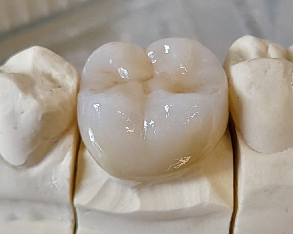 Dental Crown Example 01